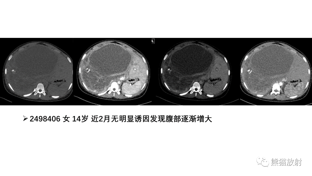 影像PPT - 【病例】肝母细胞瘤 VS FNH-49