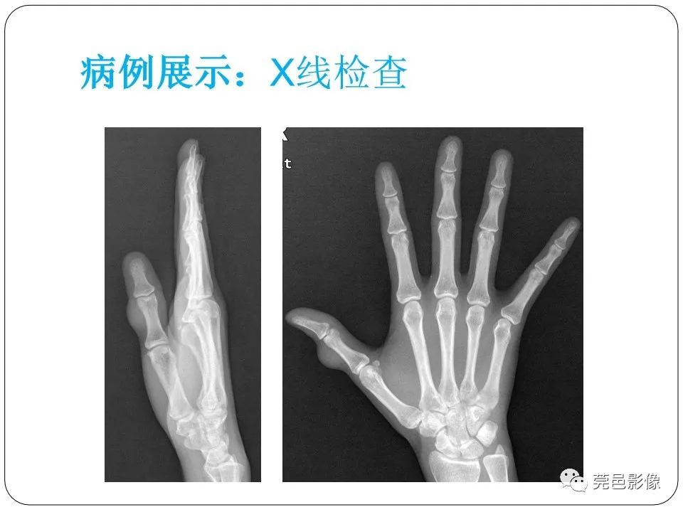 影像PPT - 【PPT】腱鞘巨细胞瘤影像诊断-3