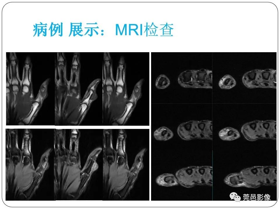 影像PPT - 【PPT】腱鞘巨细胞瘤影像诊断-4