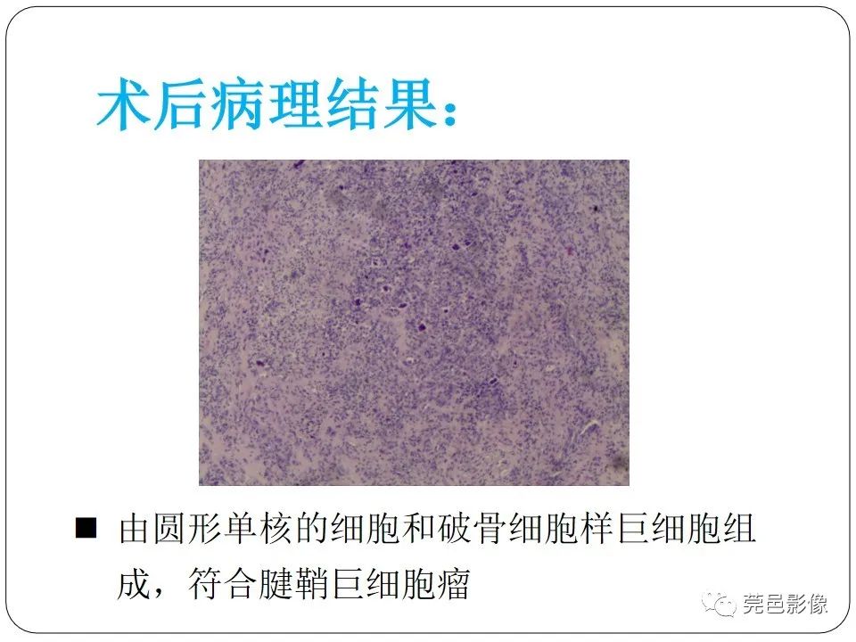 影像PPT - 【PPT】腱鞘巨细胞瘤影像诊断-6