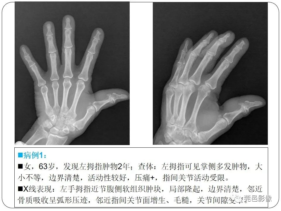 影像PPT - 【PPT】腱鞘巨细胞瘤影像诊断-12