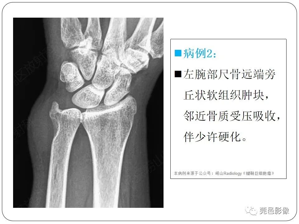 影像PPT - 【PPT】腱鞘巨细胞瘤影像诊断-13