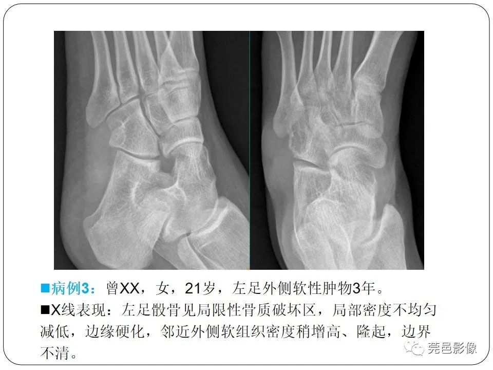 影像PPT - 【PPT】腱鞘巨细胞瘤影像诊断-14