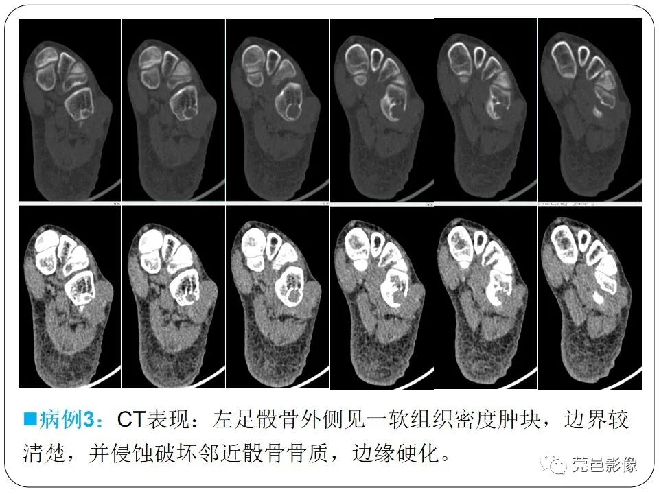 影像PPT - 【PPT】腱鞘巨细胞瘤影像诊断-15