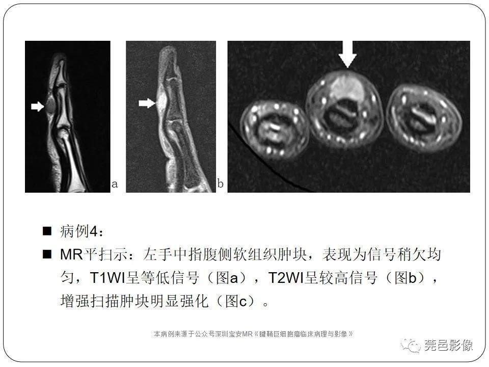影像PPT - 【PPT】腱鞘巨细胞瘤影像诊断-17