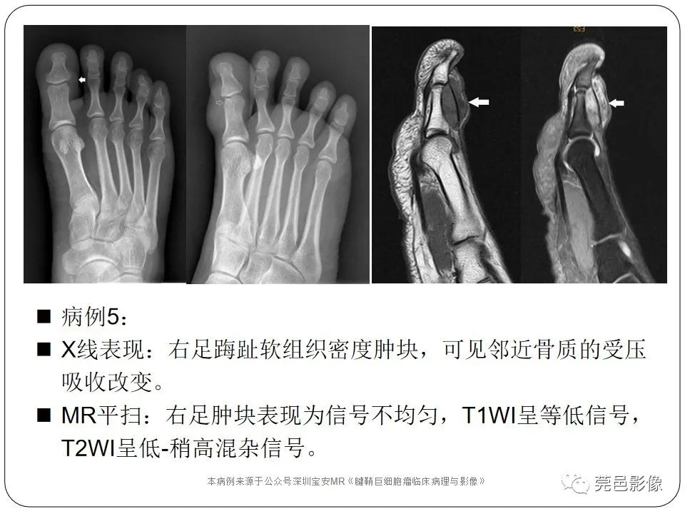影像PPT - 【PPT】腱鞘巨细胞瘤影像诊断-18