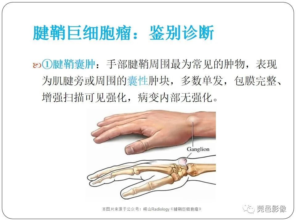 影像PPT - 【PPT】腱鞘巨细胞瘤影像诊断-19