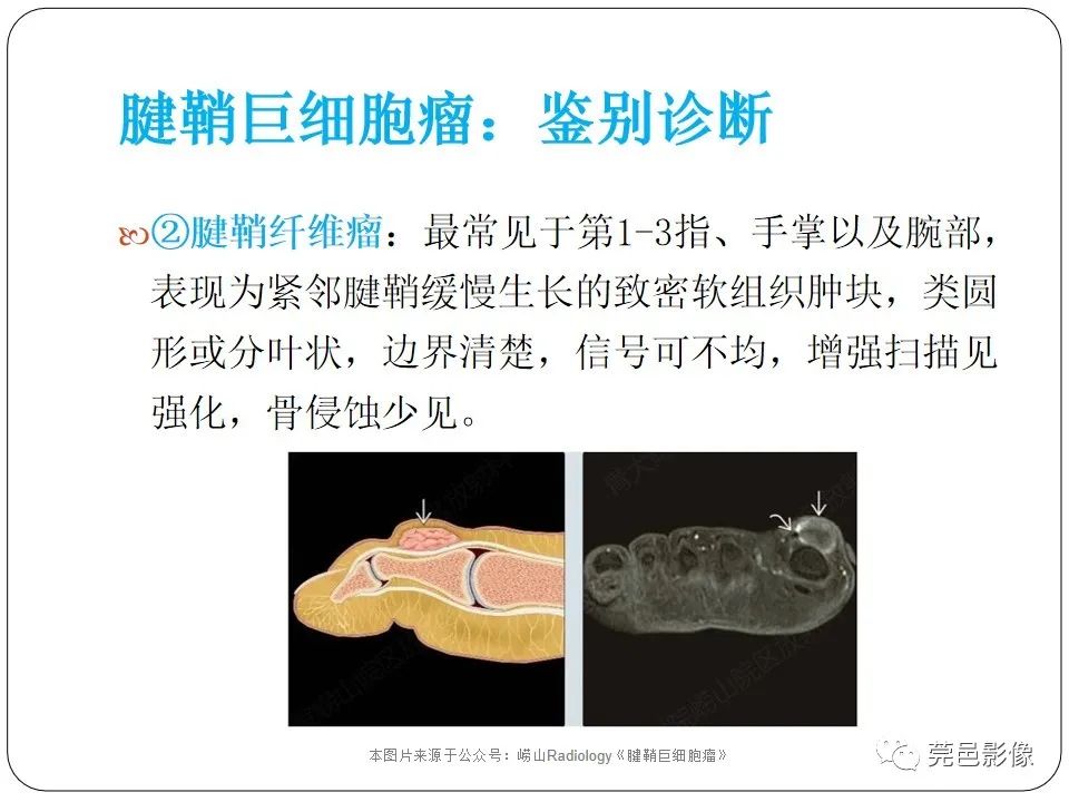 影像PPT - 【PPT】腱鞘巨细胞瘤影像诊断-20