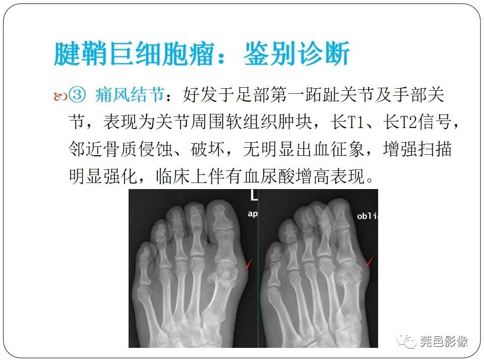 影像PPT - 【PPT】腱鞘巨细胞瘤影像诊断-21