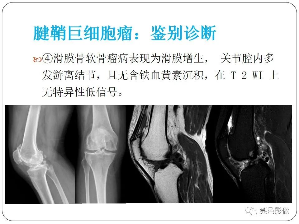 影像PPT - 【PPT】腱鞘巨细胞瘤影像诊断-22