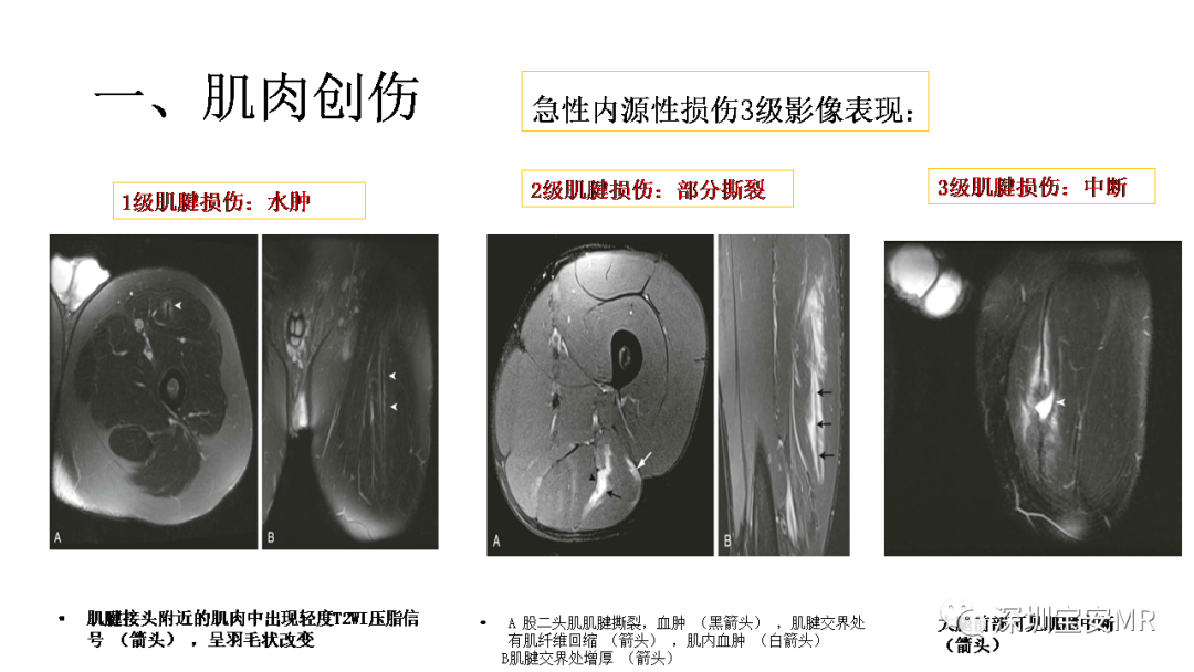 影像PPT - 【PPT】肌肉损伤和后遗症-7