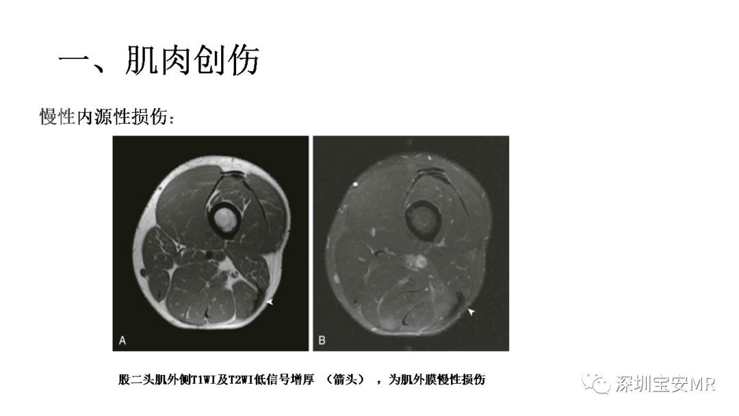 影像PPT - 【PPT】肌肉损伤和后遗症-9