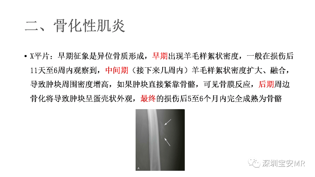 影像PPT - 【PPT】肌肉损伤和后遗症-14