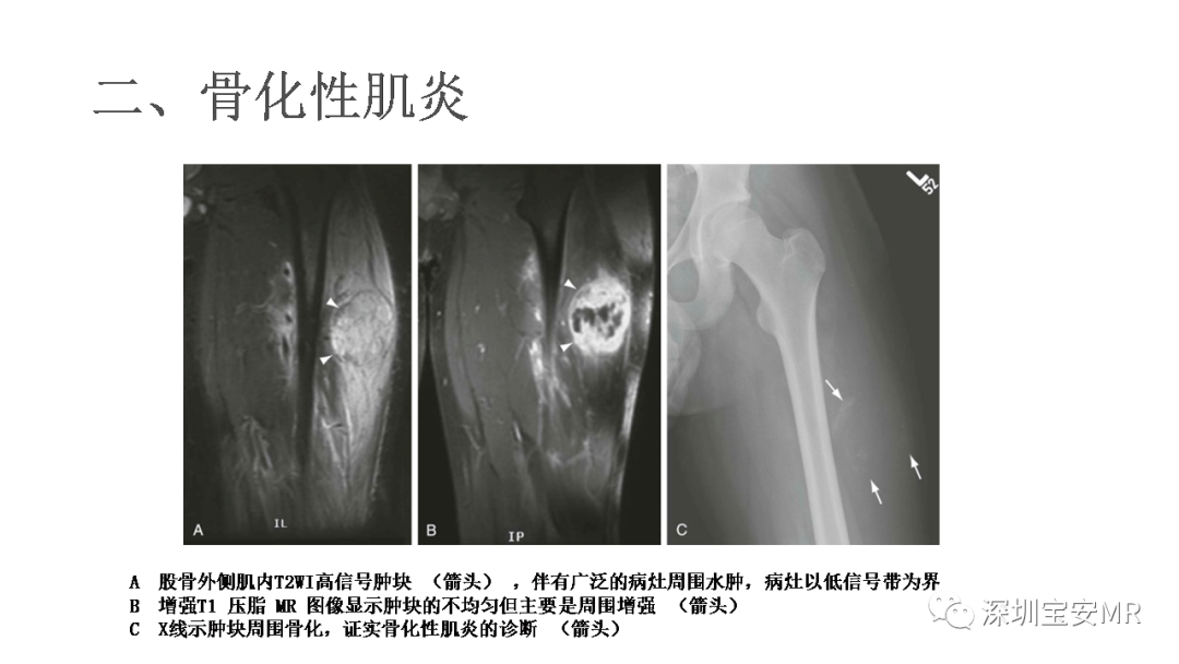 影像PPT - 【PPT】肌肉损伤和后遗症-16