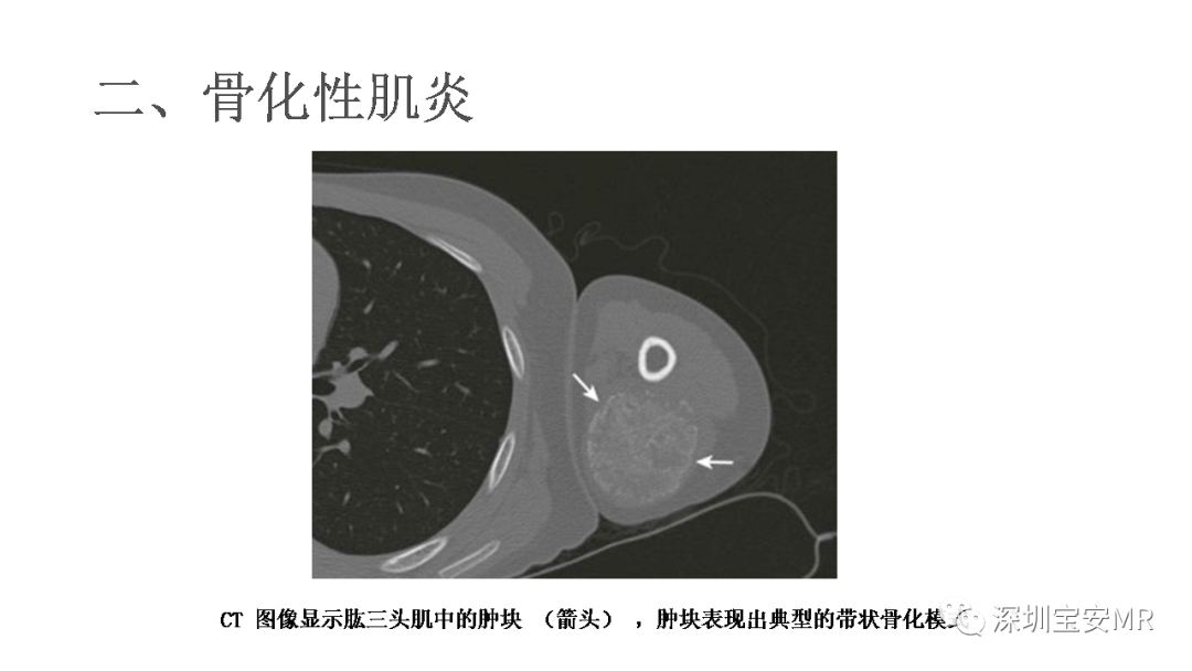 影像PPT - 【PPT】肌肉损伤和后遗症-17