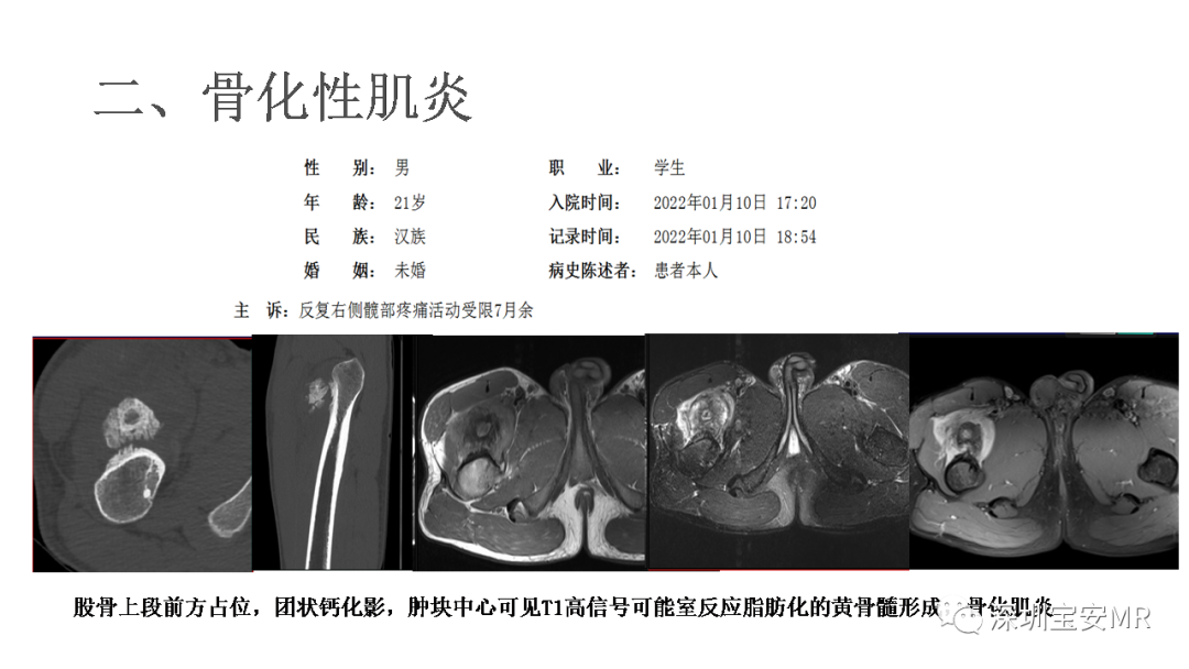 影像PPT - 【PPT】肌肉损伤和后遗症-18