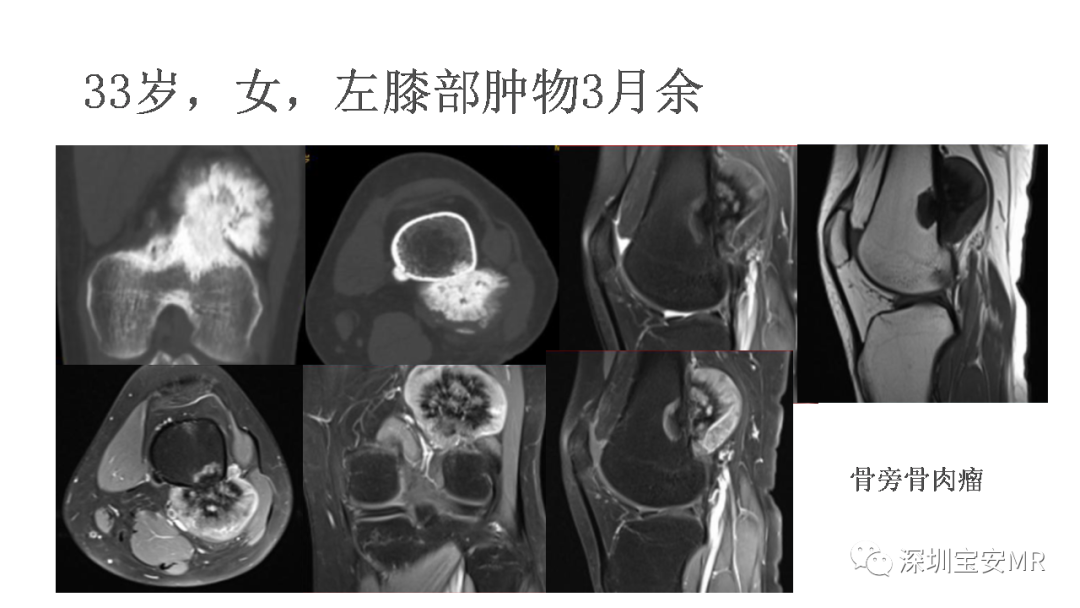 影像PPT - 【PPT】肌肉损伤和后遗症-19