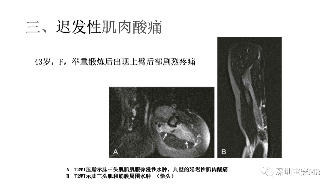 影像PPT - 【PPT】肌肉损伤和后遗症-21