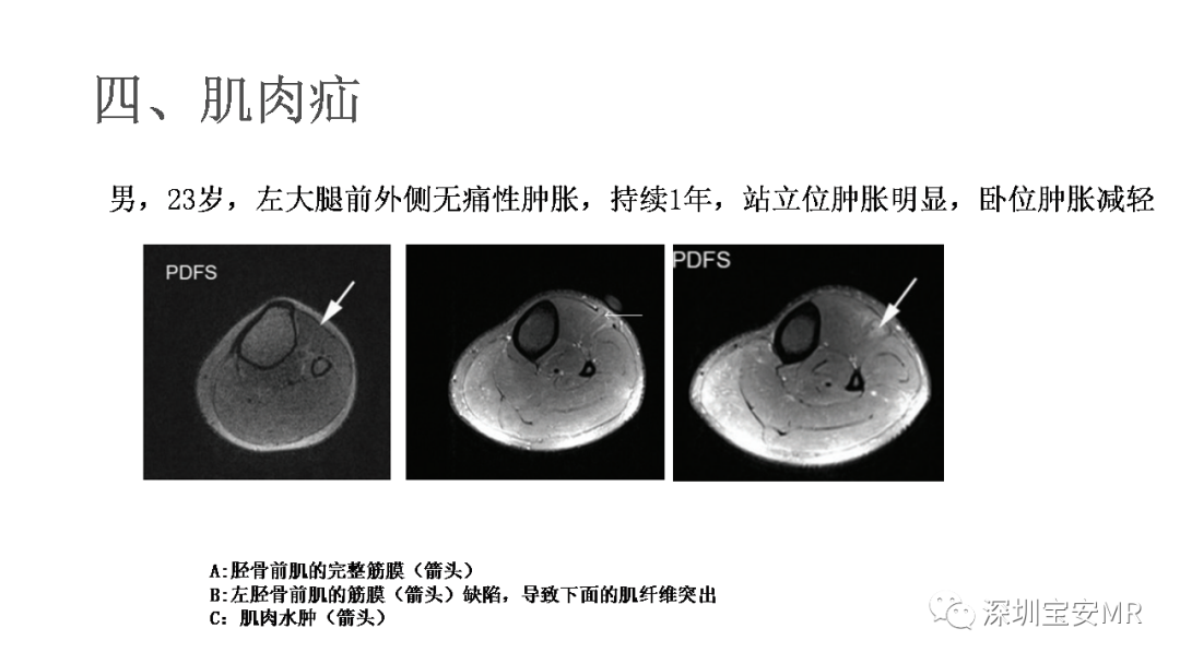 影像PPT - 【PPT】肌肉损伤和后遗症-23