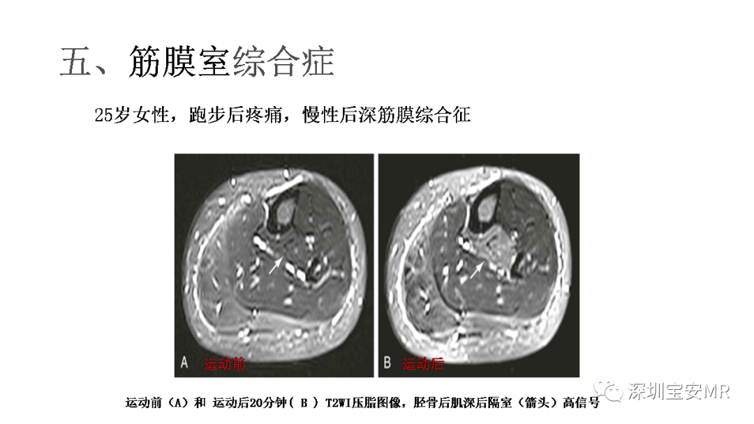影像PPT - 【PPT】肌肉损伤和后遗症-27