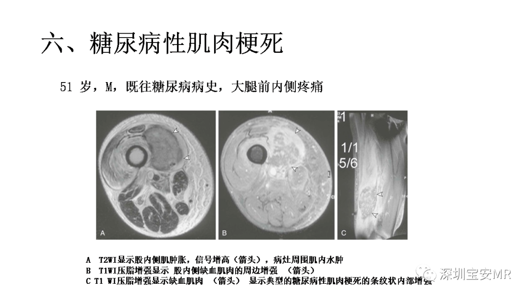影像PPT - 【PPT】肌肉损伤和后遗症-30