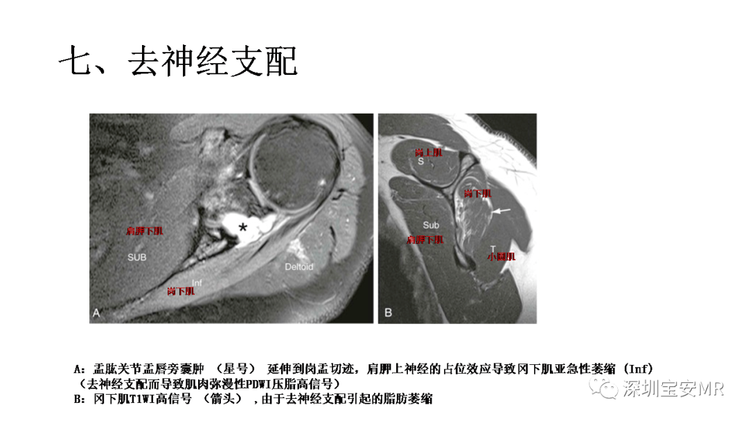 影像PPT - 【PPT】肌肉损伤和后遗症-33