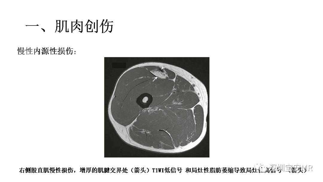 影像PPT - 【PPT】肌肉损伤和后遗症-1