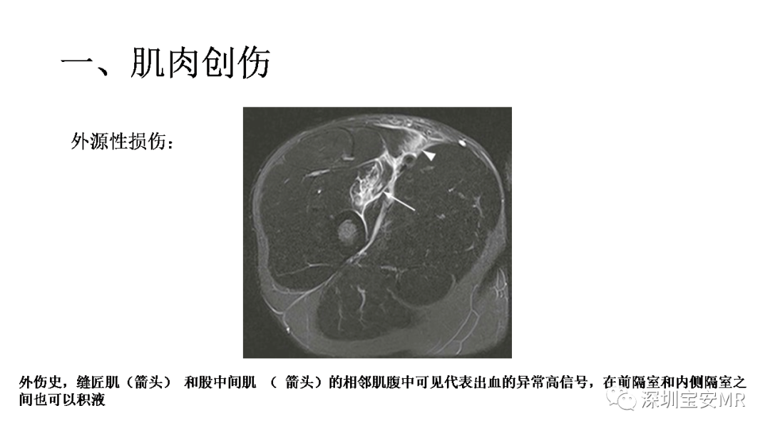 影像PPT - 【PPT】肌肉损伤和后遗症-2