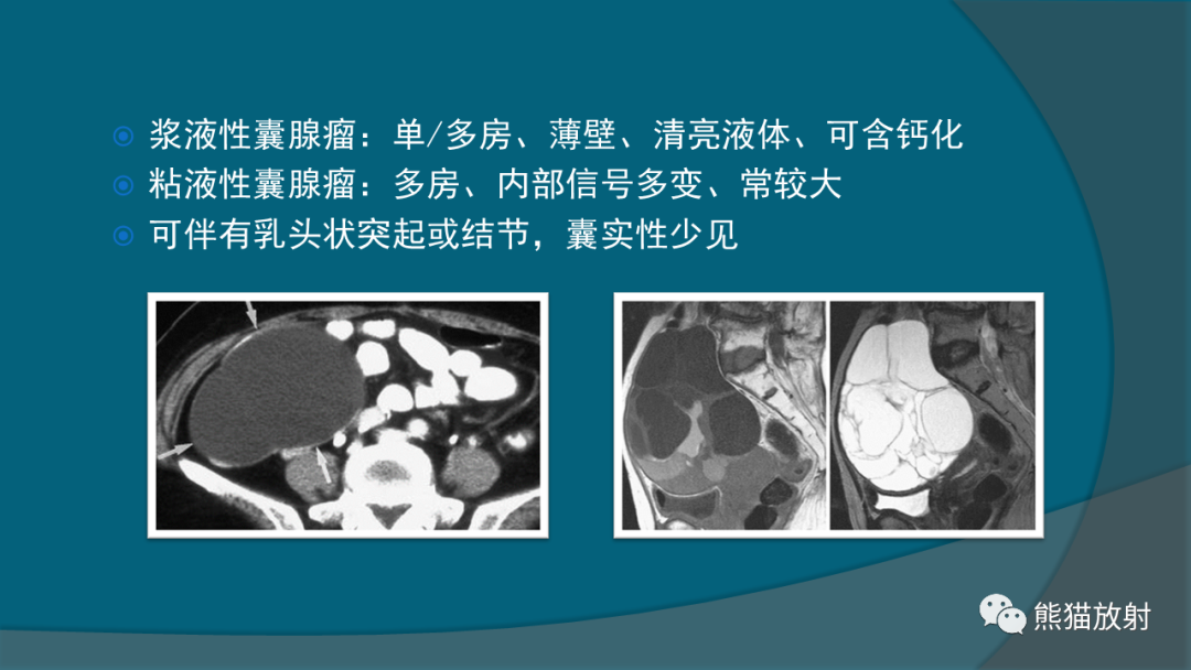 影像PPT - 【PPT】常见卵巢上皮性肿瘤-6