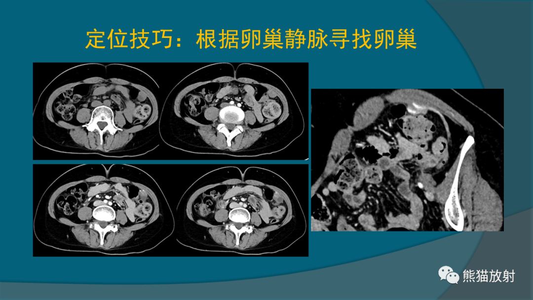 影像PPT - 【PPT】常见卵巢上皮性肿瘤-8