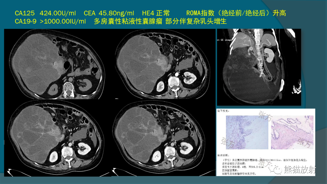 影像PPT - 【PPT】常见卵巢上皮性肿瘤-7