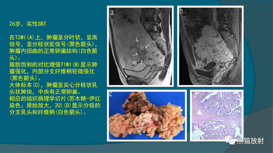 影像PPT - 【PPT】常见卵巢上皮性肿瘤-3