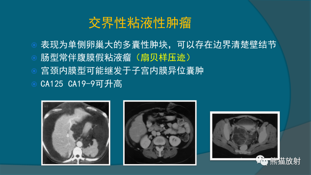 影像PPT - 【PPT】常见卵巢上皮性肿瘤-5