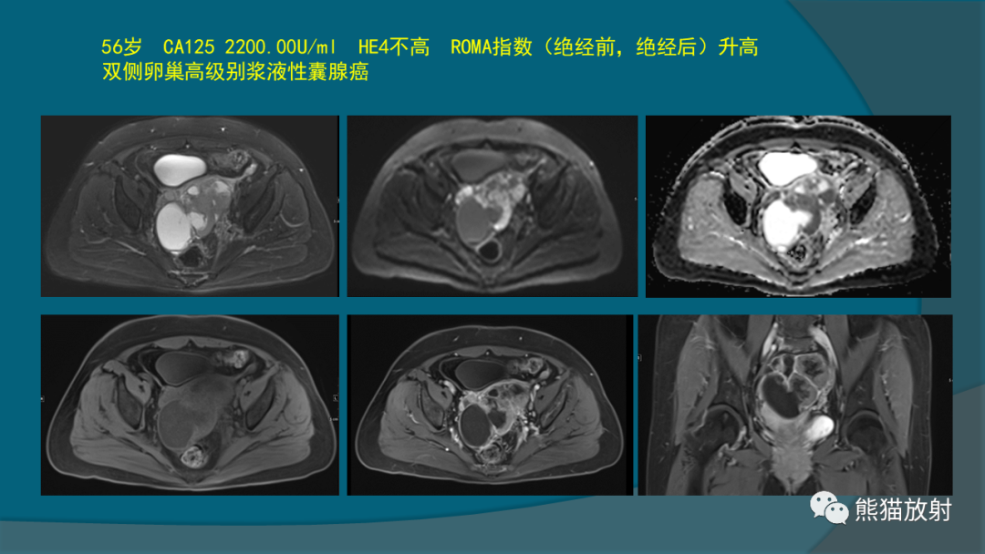 影像PPT - 【PPT】常见卵巢上皮性肿瘤-15