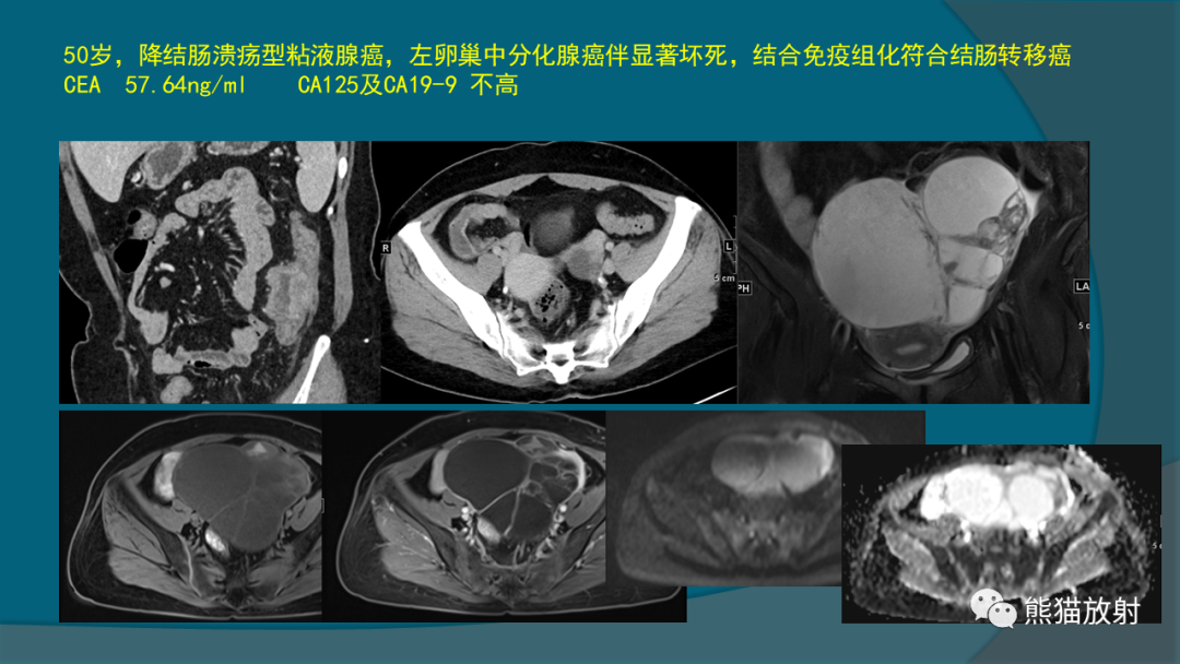 影像PPT - 【PPT】常见卵巢上皮性肿瘤-19