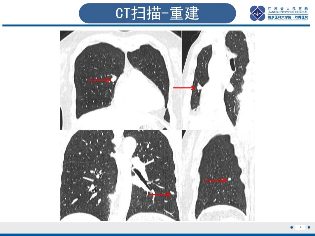 影像PPT - 【PPT】​罕见的肺内脑膜瘤结节—肺转移性脑膜瘤-5