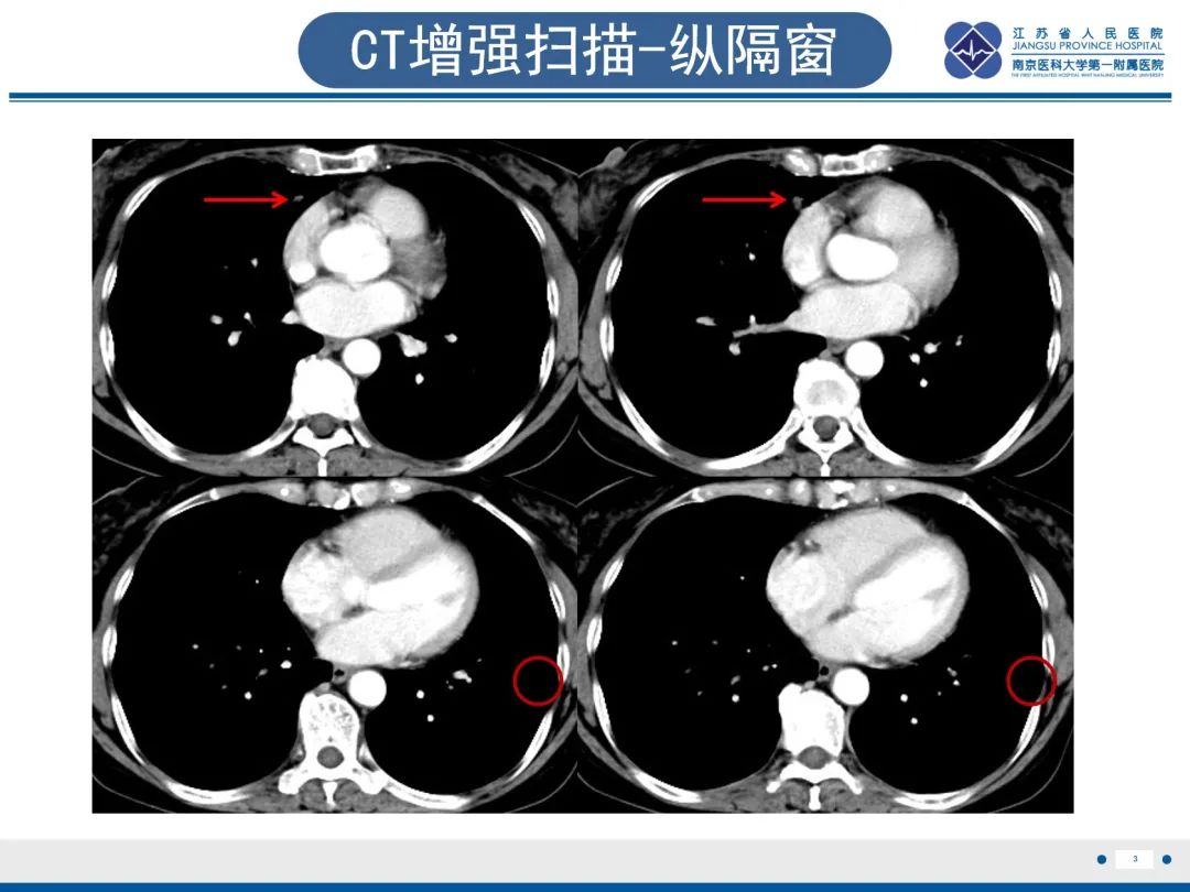 影像PPT - 【PPT】​罕见的肺内脑膜瘤结节—肺转移性脑膜瘤-4
