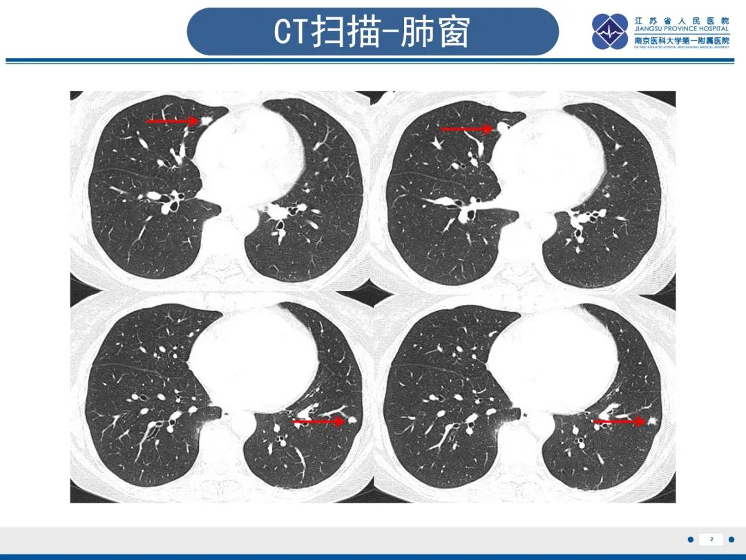 影像PPT - 【PPT】​罕见的肺内脑膜瘤结节—肺转移性脑膜瘤-3