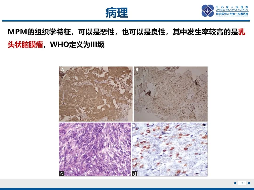 影像PPT - 【PPT】​罕见的肺内脑膜瘤结节—肺转移性脑膜瘤-16