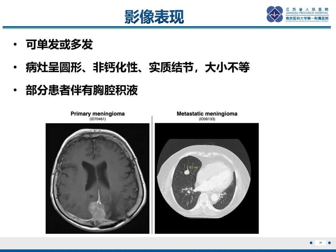 影像PPT - 【PPT】​罕见的肺内脑膜瘤结节—肺转移性脑膜瘤-21
