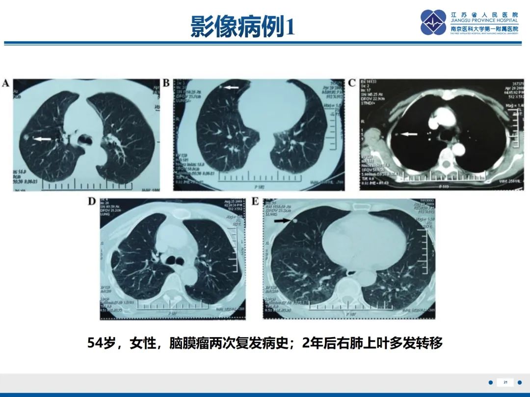 影像PPT - 【PPT】​罕见的肺内脑膜瘤结节—肺转移性脑膜瘤-22