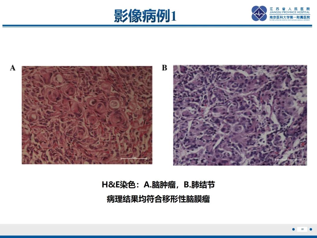 影像PPT - 【PPT】​罕见的肺内脑膜瘤结节—肺转移性脑膜瘤-23