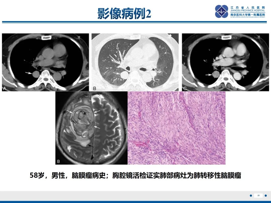 影像PPT - 【PPT】​罕见的肺内脑膜瘤结节—肺转移性脑膜瘤-24