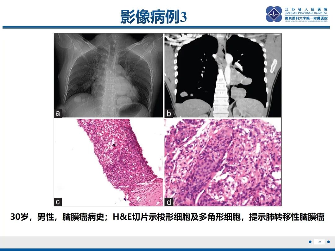 影像PPT - 【PPT】​罕见的肺内脑膜瘤结节—肺转移性脑膜瘤-25
