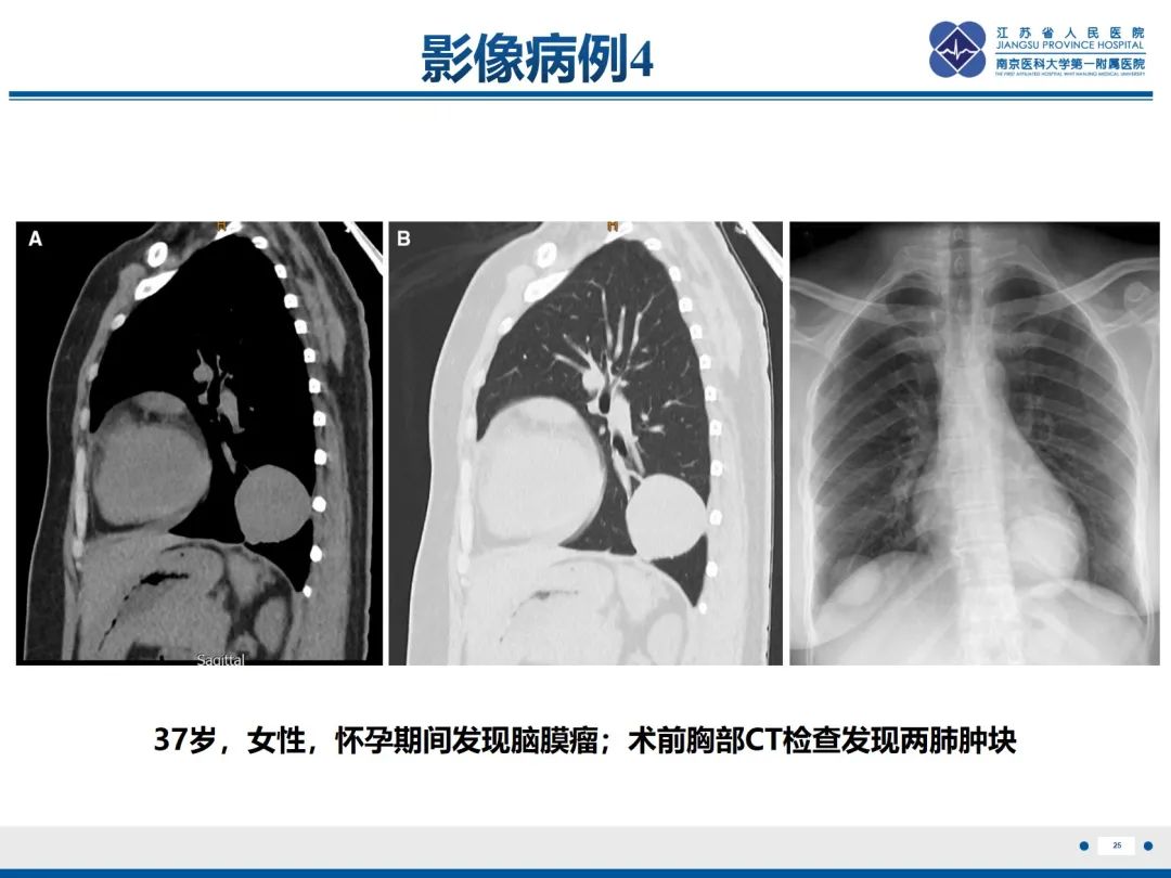 影像PPT - 【PPT】​罕见的肺内脑膜瘤结节—肺转移性脑膜瘤-26