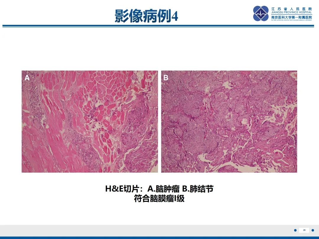 影像PPT - 【PPT】​罕见的肺内脑膜瘤结节—肺转移性脑膜瘤-27