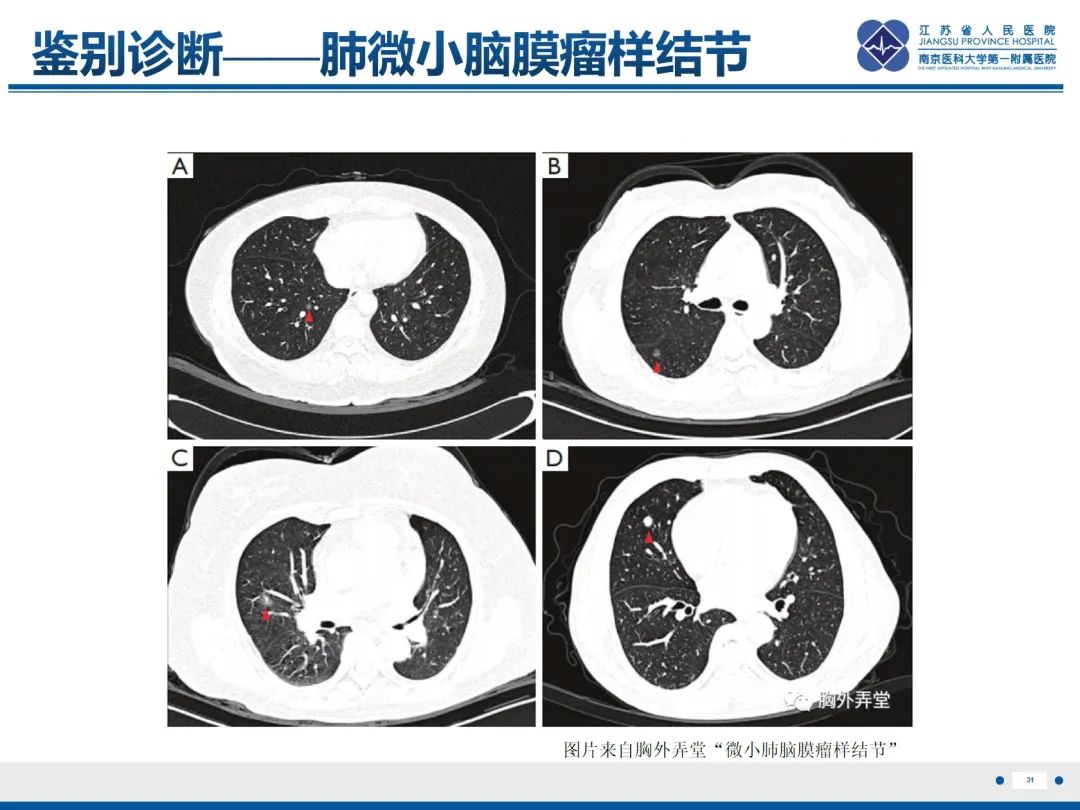 影像PPT - 【PPT】​罕见的肺内脑膜瘤结节—肺转移性脑膜瘤-32