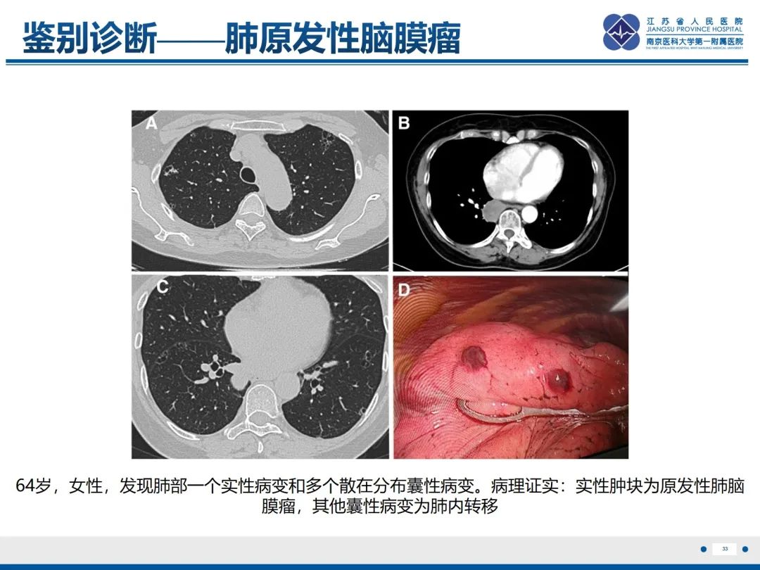 影像PPT - 【PPT】​罕见的肺内脑膜瘤结节—肺转移性脑膜瘤-34