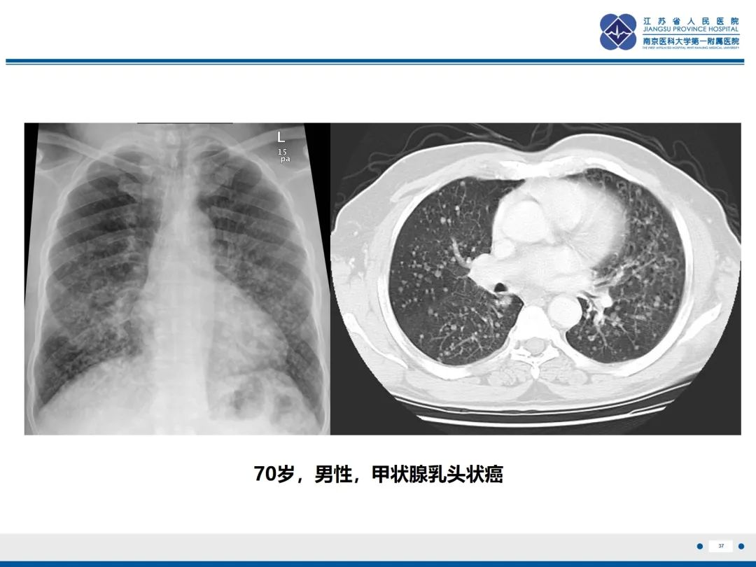 影像PPT - 【PPT】​罕见的肺内脑膜瘤结节—肺转移性脑膜瘤-38