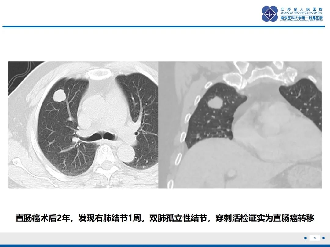 影像PPT - 【PPT】​罕见的肺内脑膜瘤结节—肺转移性脑膜瘤-39